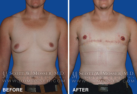 Is Swelling After FTM Chest Surgery? -
