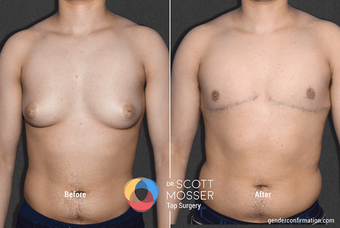 FtM Top surgery by Double Incision Mastectomy and Nipple Grafting 3950