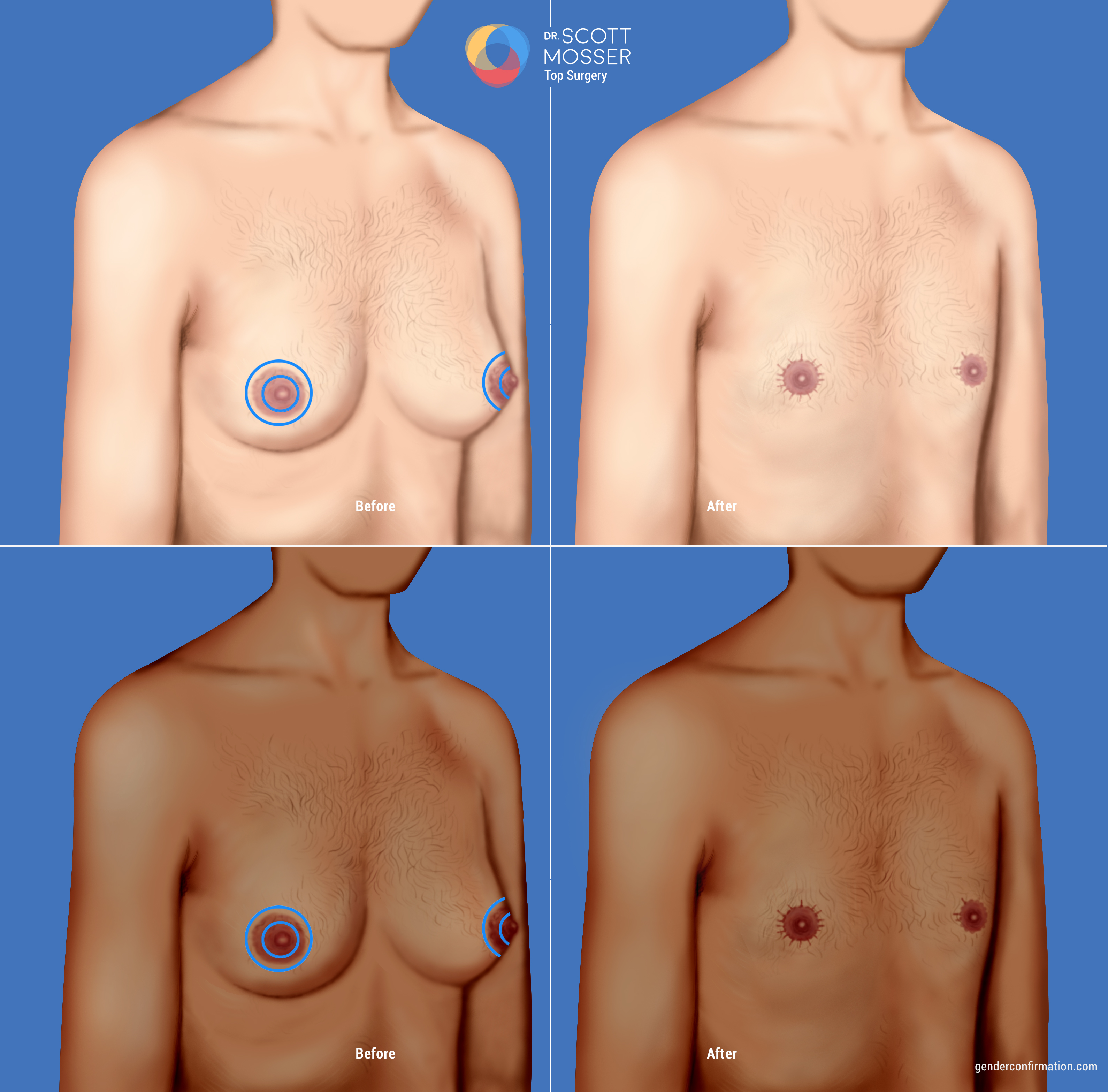 Complete resection of the nipple before and after double purse