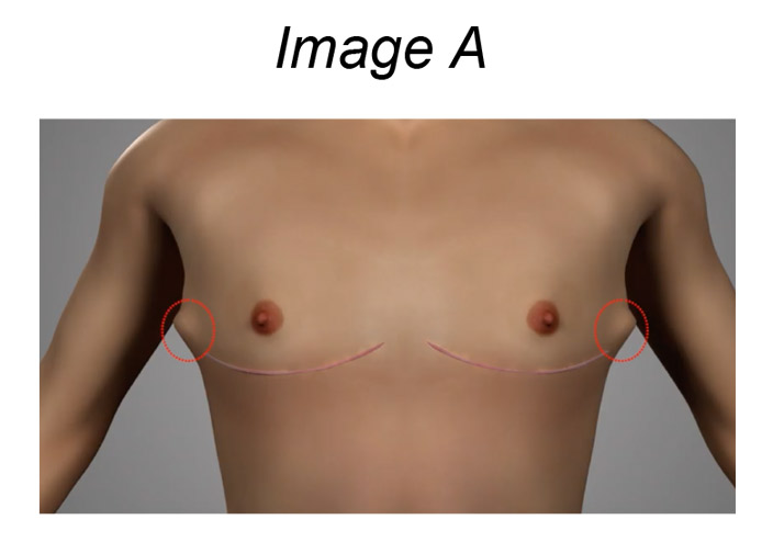 Is Breast Reduction Surgery Right For Me?