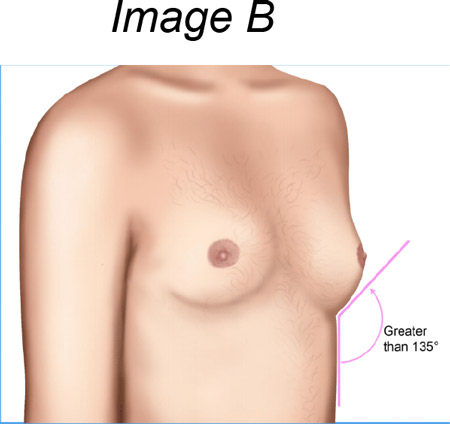 22-year-old FtM patient with a BMI of 40.62 kg/m 2 and D cup breasts