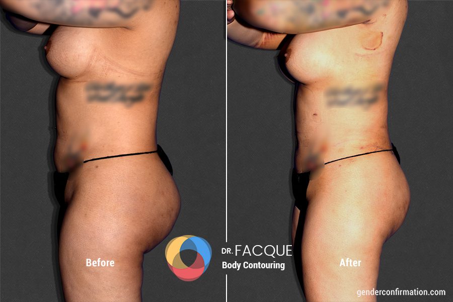 Body Feminization Surgery - Gender Confirmation