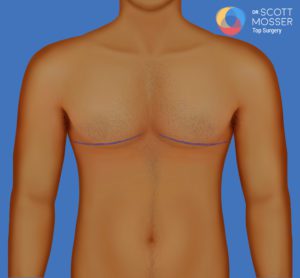 Nipple Repositioning & Skin Excision