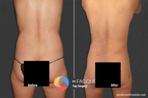 Gender Nullification Transgender Body Contouring | Gender Confirmation Center