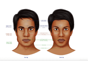 Medical illustrations shows the different parts of the face that can be altered through FFS