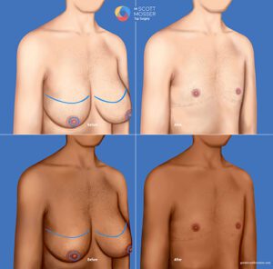 Top surgery double inisicion