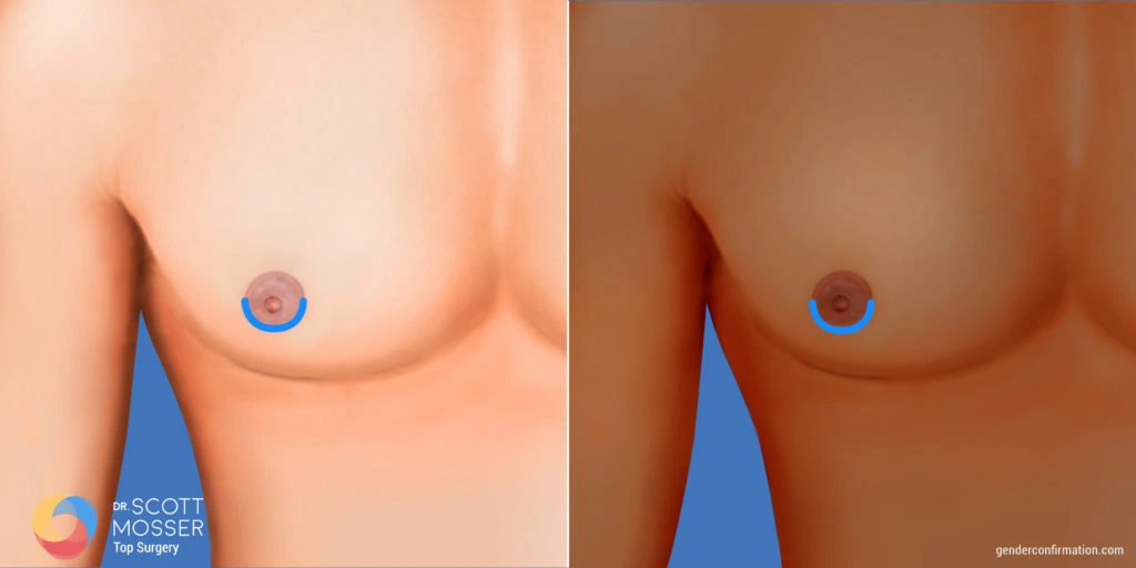 Keyhole Top Surgery Keyhole Top Surgery