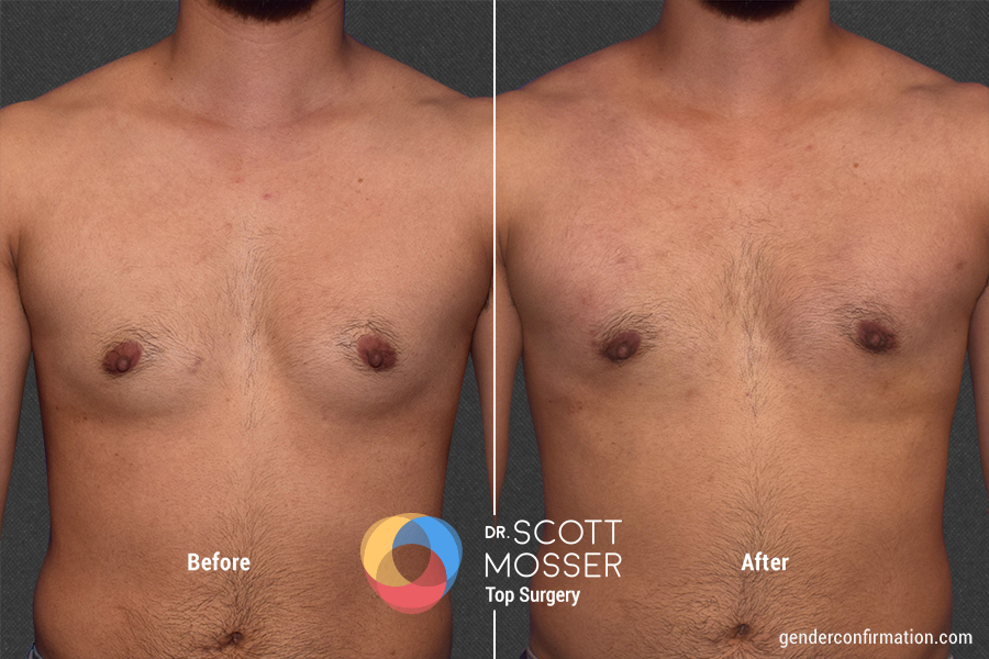 How Much is Top Surgery: A Detailed Guide
