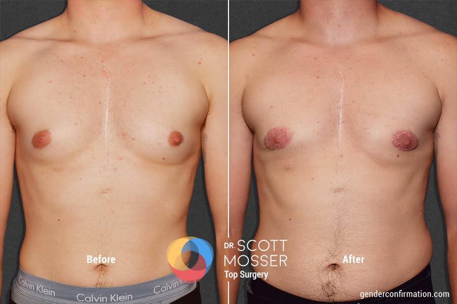 Periareolar chest reconstruction